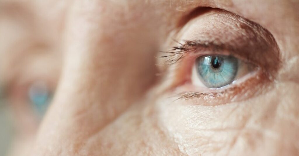 Cataracts