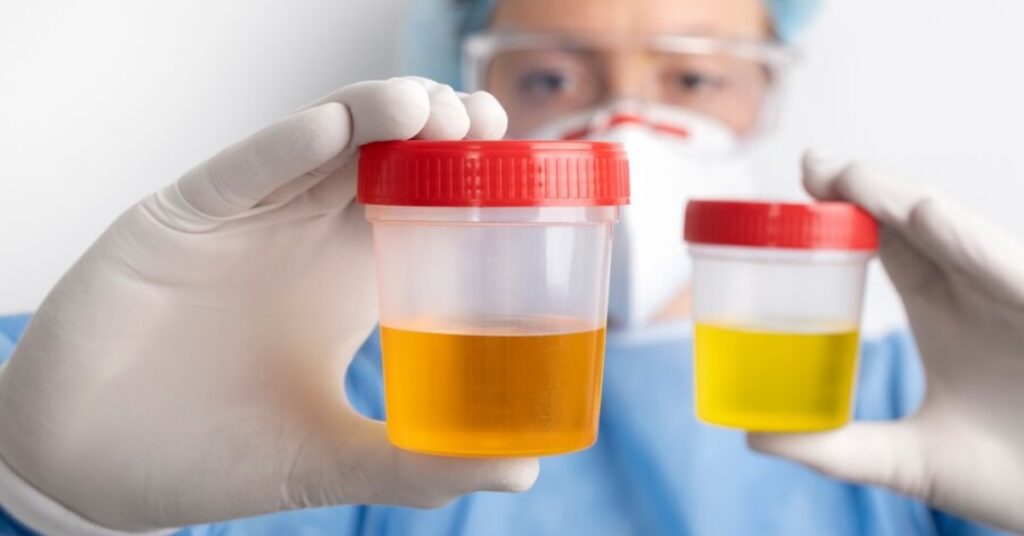 Dark Urine
