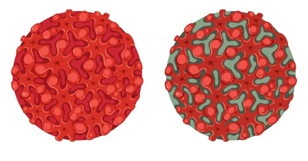 High Eosinophils