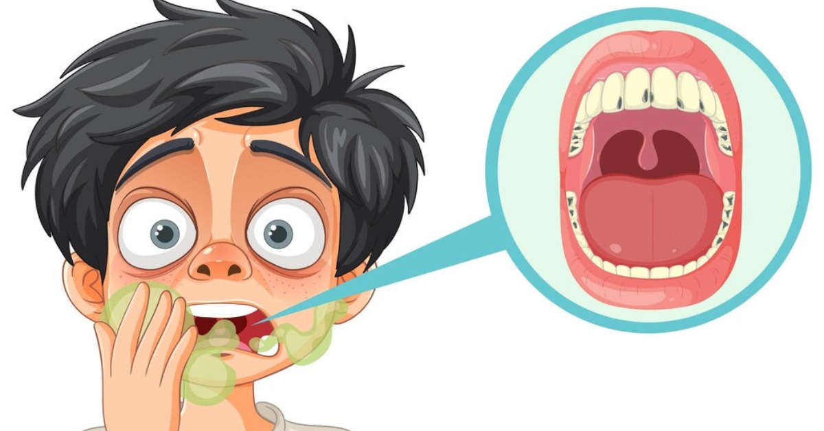 Oral Thrush