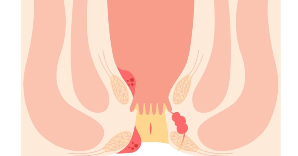 Anal itching treatment in Indore