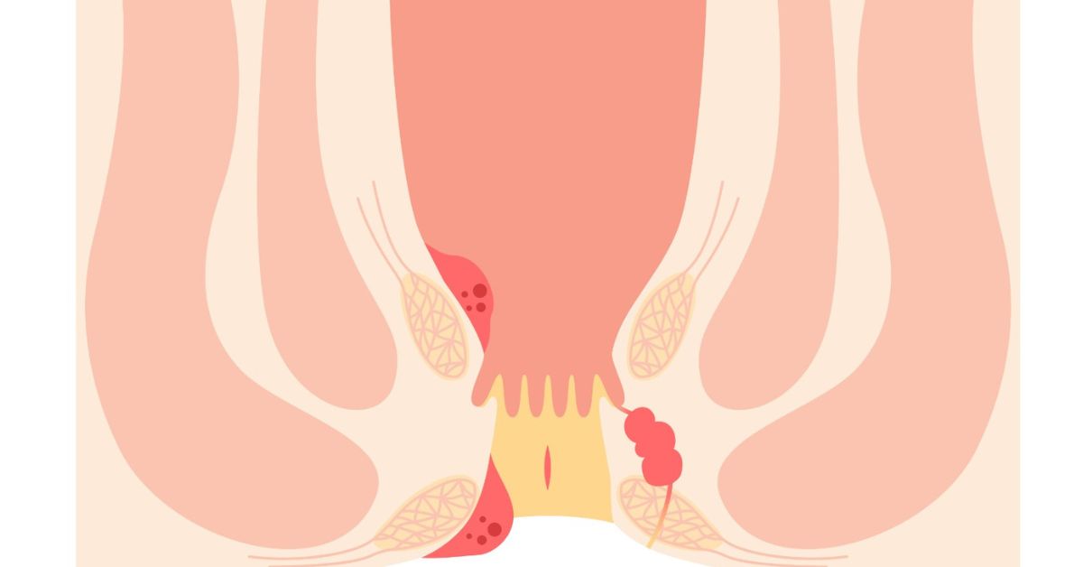 Anal itching treatment in Indore