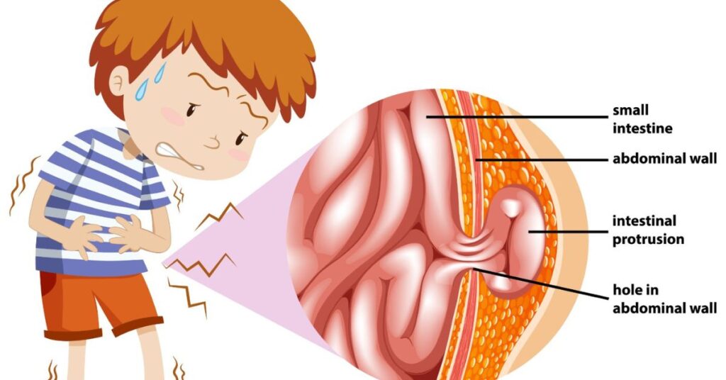 types of hernia and dangerous hernia treatment in Indore