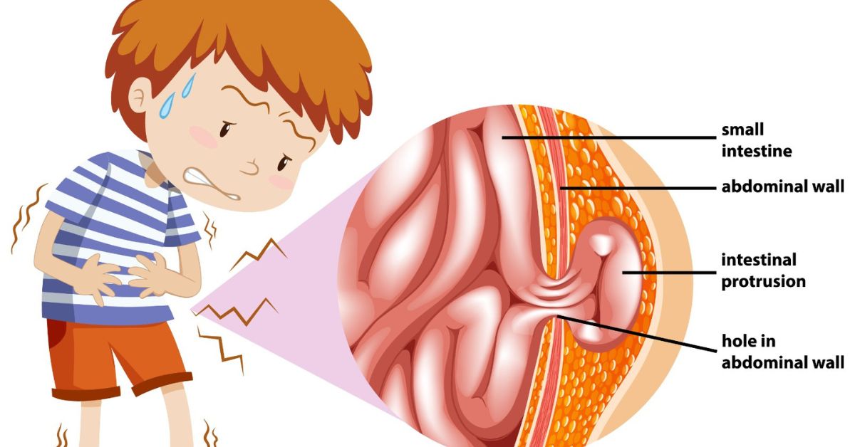 types of hernia and dangerous hernia treatment in Indore