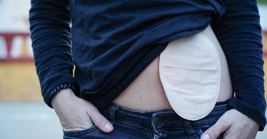 living with hernia without surgery explained by hernia surgeon in indore