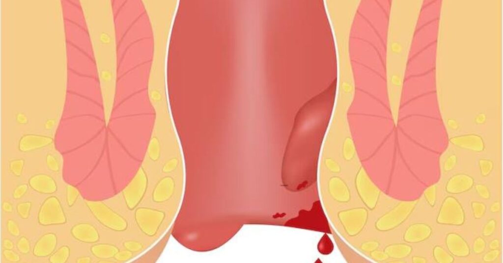 Modern piles treatment in Indore for pain relief and comfortable recovery