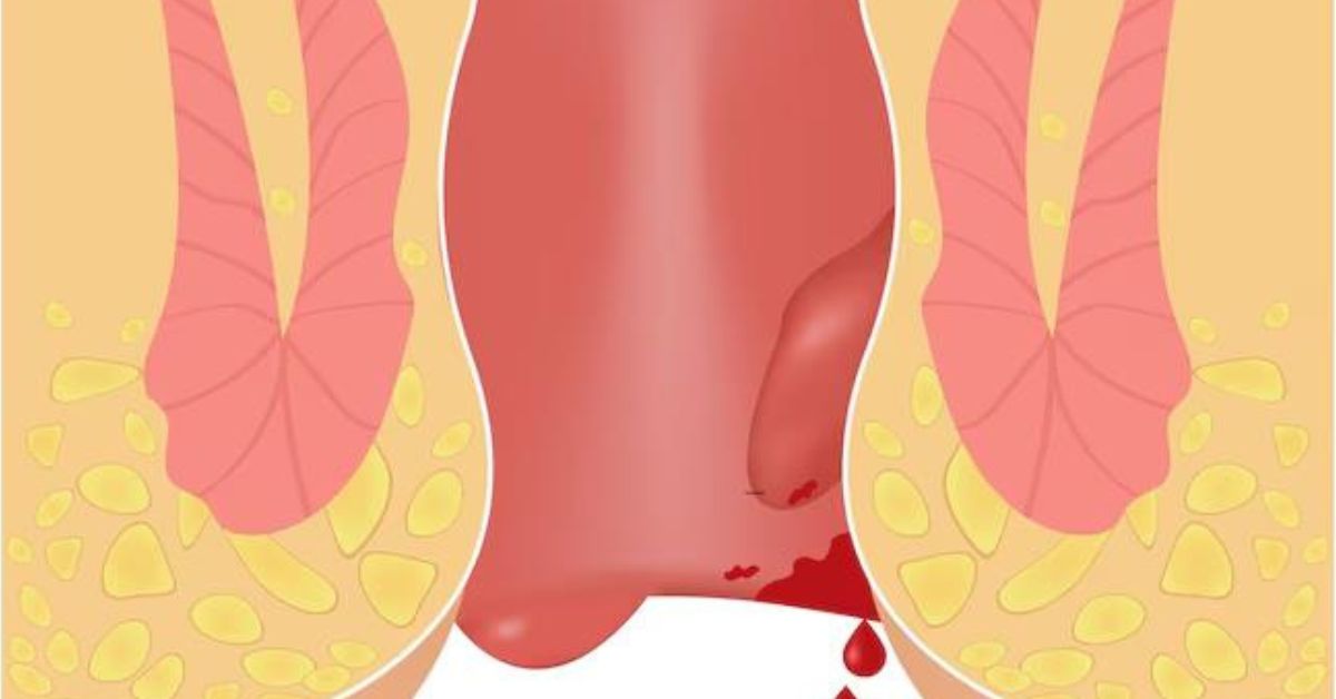 Modern piles treatment in Indore for pain relief and comfortable recovery